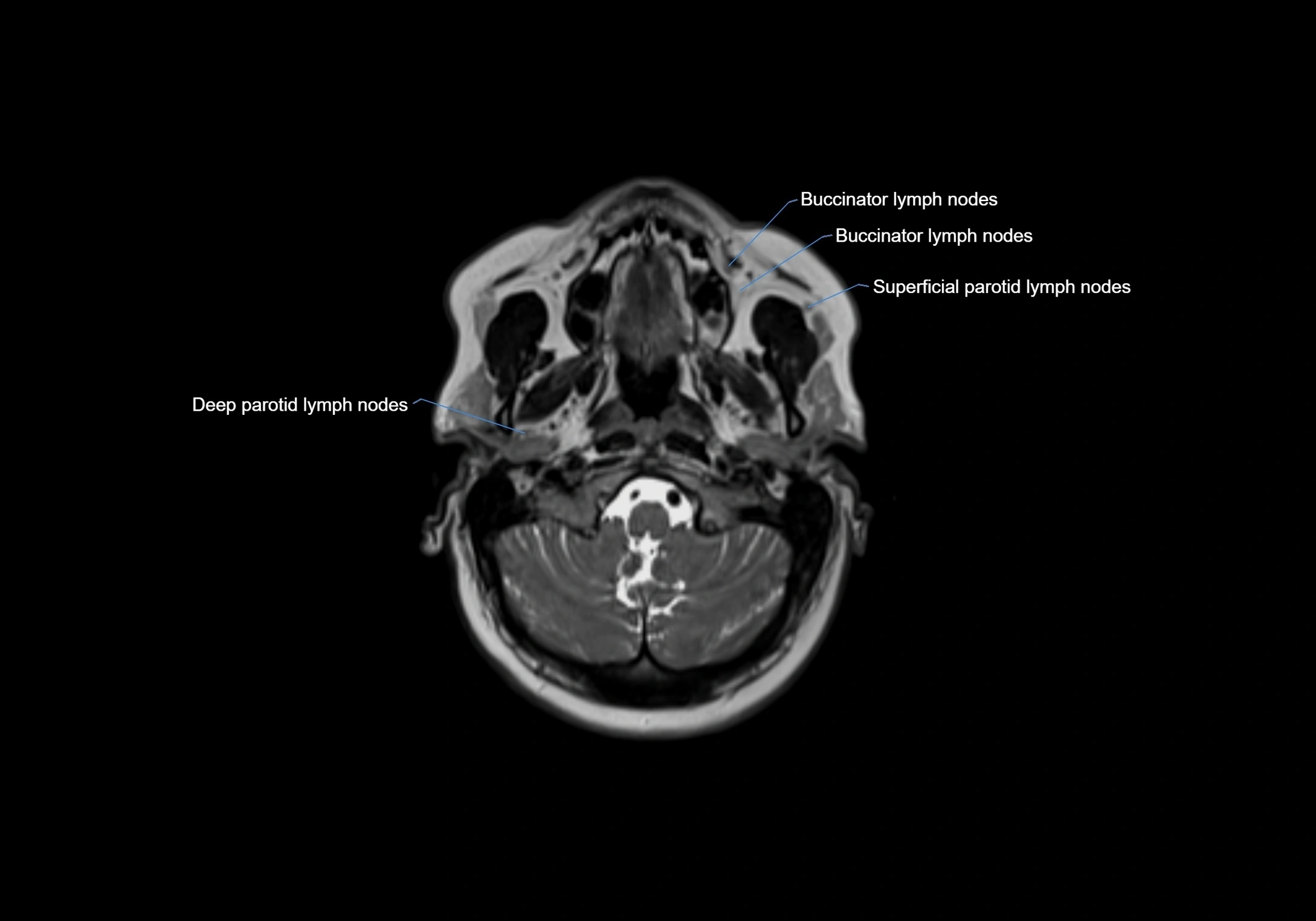 Neck axial  lymph node cross sectional MRI anatomy 3T MRI  image-img-00001-00024.webp